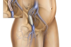 PAD Peripheral Artery Disease