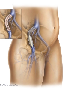 Peripheral Venous Disease in the iliac vein being treating with a stent and post dilation balloon