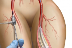 Balloon Angioplasty for Peripheral Artery Disease.