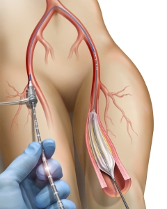 Balloon angioplasty via femoral artery access is a minimally invasive, typically outpatient procedure used to open blocked, narrowed, or diseased arteries by inserting a catheter into the groin, inflating a small balloon to compress plaque, and restoring blood flow.