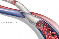 Flared A-V Graft