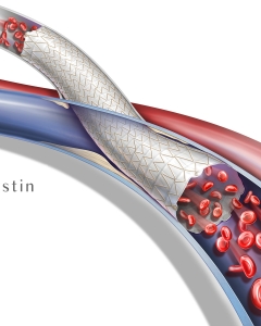 Flared A-V Graft