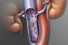IVC Filter