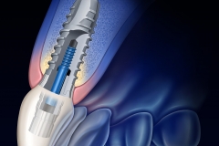 This illustration of a dental implant was created for product marketing.