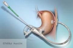 Feeding Tube Brush