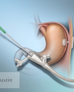 A feeding tube in the stomach (gastrostomy or G-tube) is inserted via a 30–45 minute outpatient procedure, usually a Percutaneous Endoscopic Gastrostomy (PEG), using sedation and local anesthesia to pass a tube through the abdominal wall into the stomach.