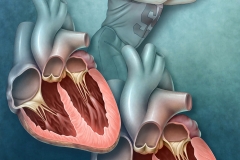 Hypertrophic Cardiomyopathy