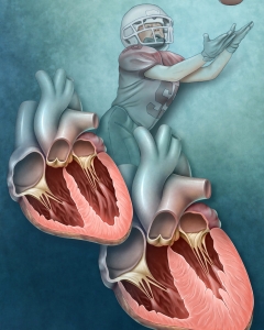 Hypertrophic cardiomyopathy (HCM) is a genetic heart condition causing the left ventricle muscle wall to thicken and stiffen, often leading to reduced blood flow, arrhythmias, and, rarely, sudden death.