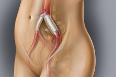 Iliac Artery Stents
