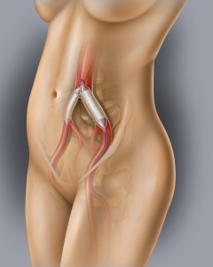 Iliac stent placement is a minimally invasive, typically outpatient, endovascular procedure used to treat narrowed (stenosis) or blocked iliac veins or arteries in the pelvis. Treats iliac vein compression syndrome (May-Thurner syndrome) or peripheral artery disease (PAD) in the pelvic region.