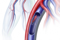 Iliac/Femoral Fistula