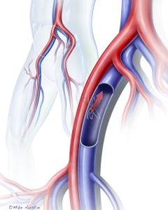 Iliac/Femoral Fistula creation via an endoluminal procedure.