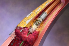 A device that depicts the removal of instent restenosis and thrombus.