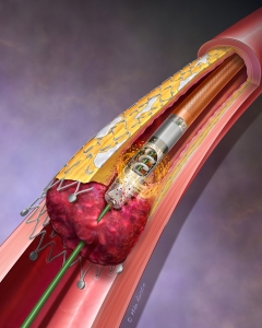 A device that depicts the removal of instent restenosis and thrombus.