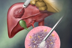 Liver Tumor Injection