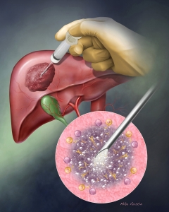 Liver Tumor Injection Treatment to kill cancer.