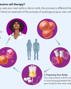 This five-step illustration of lupus cell therapy visually explains the process of immune cell collection, modification, and reinfusion to treat autoimmune disease. Designed for clarity and accuracy, it transforms complex immunology into an accessible and engaging visual.