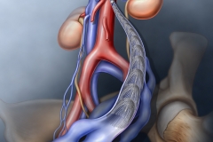 Pelvic Congestion Syndrome