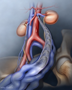 Pelvic Congestion Syndrome (PCS), or pelvic venous disorder, is a chronic pain condition caused by dysfunctional valves in pelvic veins, causing blood to pool (varicose veins) and engorge around the ovaries and uterus.