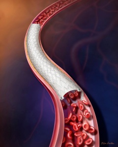 Depiction of a stent graft treating atherosclerotic disease in a peripheral artery. Depiction of a stent graft treating atherosclerotic disease in a peripheral artery.