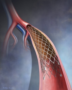 Peripheral Artery Stent