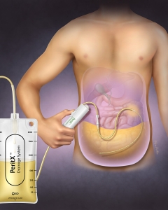 Peritoneal Cavity Drainage