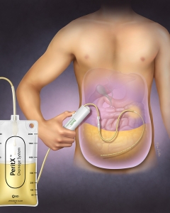 Paracentesis procedure to remove ascites from the peritoneal cavity in the abdomen.