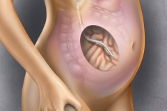 Implantable Peritoneal Port