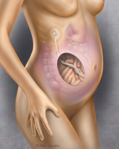 Implantable Peritoneal Port