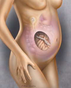 An implantable peritoneal port is a small, surgically placed,, medically implanted device under the skin, often on the chest or abdomen, used for long-term access to the abdominal cavity. It features a silicone top for needle access, allowing for minimally invasive, repeated, or continuous intraperitoneal (IP) chemotherapy or draining of excessive abdominal fluid (ascites).