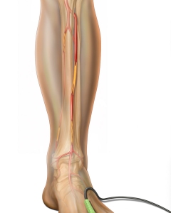 A QuantaFlo pad is a non-invasive, point-of-care device using infrared sensors on fingers and toes to measure blood flow fluctuations, aiding in the rapid screening and detection of Peripheral Arterial Disease (PAD) by calculating Ankle-Brachial Index (ABI) ratios, A QuantaFlo pad is a non-invasive, point-of-care device using infrared sensors on fingers and toes to measure blood flow fluctuations, aiding in the rapid screening and detection of Peripheral Arterial Disease (PAD) by calculating Ankle-Brachial Index (ABI) ratios,