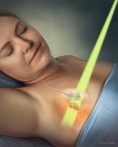 Radiation therapy for breast cancer going through a metal-free implantable port.