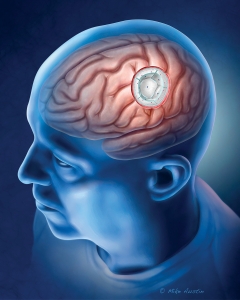 Radiation Tiles for Brain Tumors