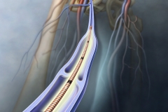 Saphenous Vein Ablation