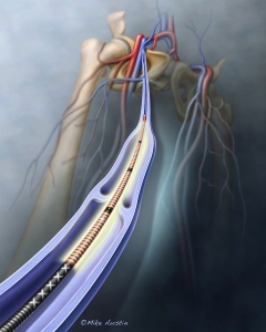 Saphenous vein ablation is a minimally invasive procedure designed to treat chronic venous insufficiency and symptomatic varicose veins by using heat (radiofrequency or laser) or chemicals to seal off diseased veins.