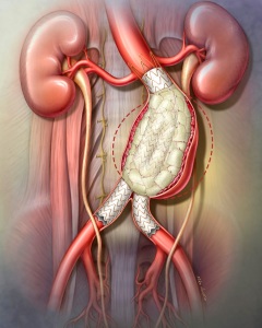 This illustration was created as a showpiece for participants in a clinical trial for treating abdominal aortic aneurysms with an endoluminal graft in combination with embolization plugs for the intended reduction of the aneurysmal sac size. This illustration was created as a showpiece for participants in a clinical trial for treating abdominal aortic aneurysms with an endoluminal graft in combination with embolization plugs for the intended reduction of the aneurysmal sac size.