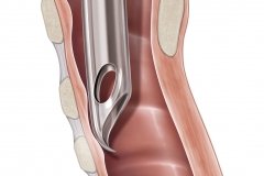 Tracheal Tube