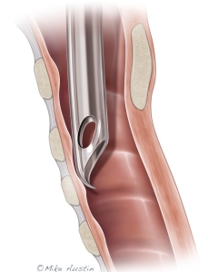 A tracheal tube, often referred to as a tracheostomy tube or "trach" tube, is a 2- to 3-inch long curved plastic or metal device inserted through a surgical opening in the neck (stoma) into the trachea.