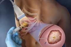 Cover illustration depicting a substance that's injected into a liver tumor for tumor ablation