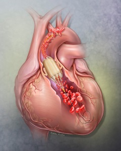 The True™ Flow Valvuloplasty Perfusion Catheter (BD) is a specialized balloon catheter used to treat stenotic (narrowed) heart valves by allowing continuous blood flow during inflation, reducing the need for rapid pacing.