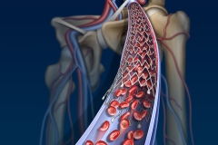 Venous stent