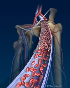 Venous stent placed via an endoluminal procedure to treat venous thrombotic disease.