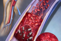 Cover illustration for futuristic magnetic "bots" that could work their way through thrombus occlusions