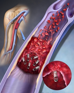 Cover illustration for futuristic magnetic "bots" that could work their way through thrombus occlusions