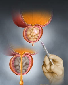 Benign prostatic hyperplasia (BPH) is a noncancerous enlargement of the prostate that commonly affects men over 50, causing lower urinary tract symptoms like weak stream, frequency, urgency, and incomplete emptying.