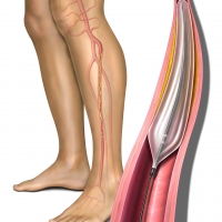 Peripheral Artery Disease