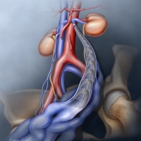 Pelvic Congestion Syndrome (PCS), or pelvic venous disorder, is a chronic pain condition caused by dysfunctional valves in pelvic veins, causing blood to pool (varicose veins) and engorge around the ovaries and uterus.