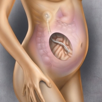 An implantable peritoneal port is a small, surgically placed,, medically implanted device under the skin, often on the chest or abdomen, used for long-term access to the abdominal cavity. It features a silicone top for needle access, allowing for minimally invasive, repeated, or continuous intraperitoneal (IP) chemotherapy or draining of excessive abdominal fluid (ascites).