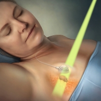 Radiation therapy for breast cancer going through a metal-free implantable port.